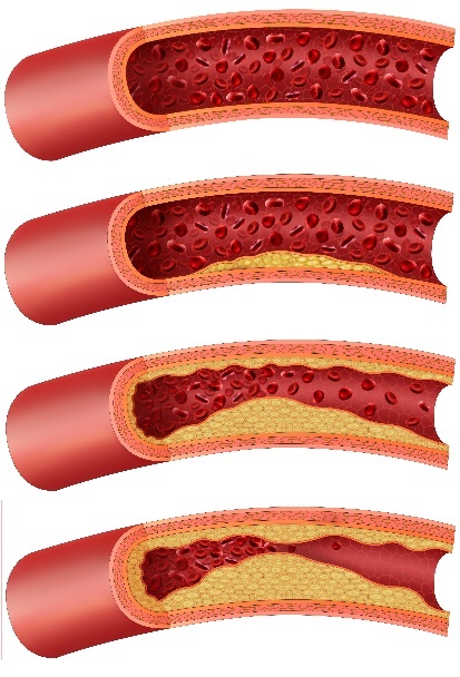 Progressive narrowing of a coronary artery